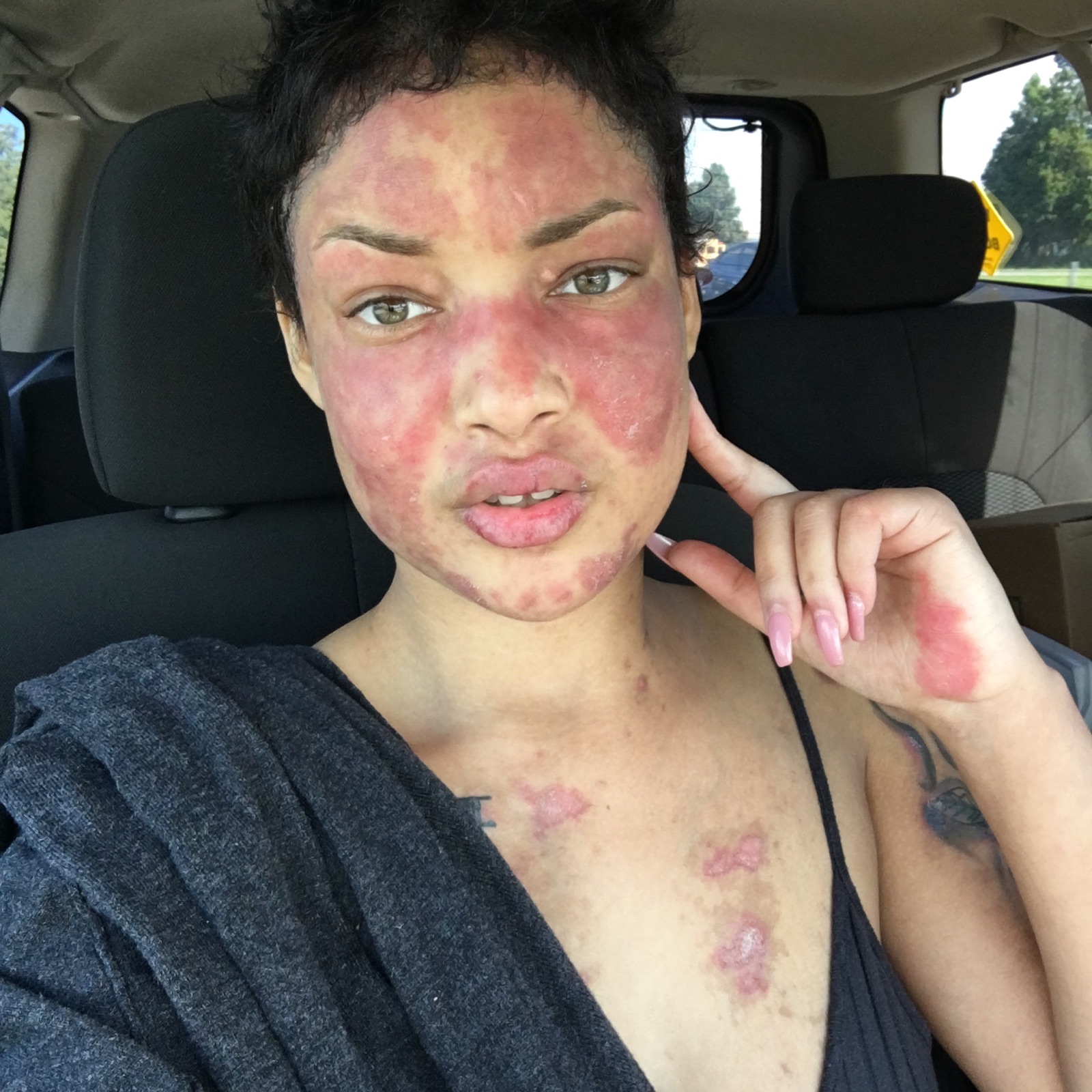 Jokiva Bellard lupus rash on face 